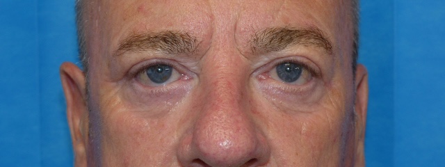 PM Upper Eyelid Front After PM Upper Eyelid Front After