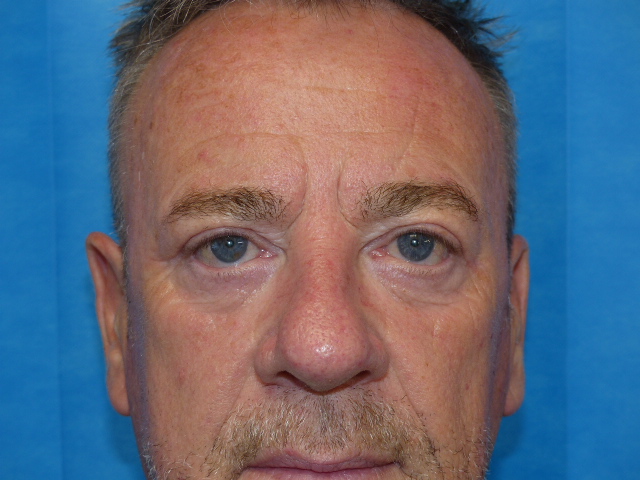 PM Upper Eyelid Front After