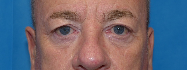 PM Upper Eyelid Front Before PM Upper Eyelid Front Before