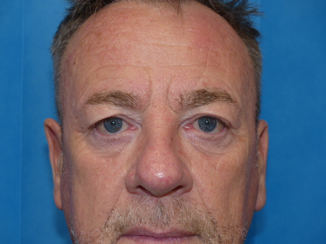 PM Upper Eyelid Front Before