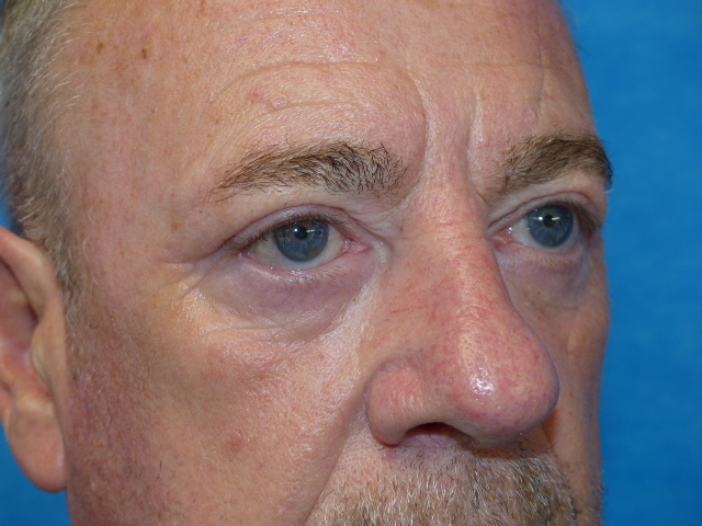 PM Upper Eyelid Side After