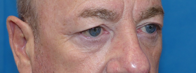 PM Upper Eyelid Side Before PM Upper Eyelid Side Before