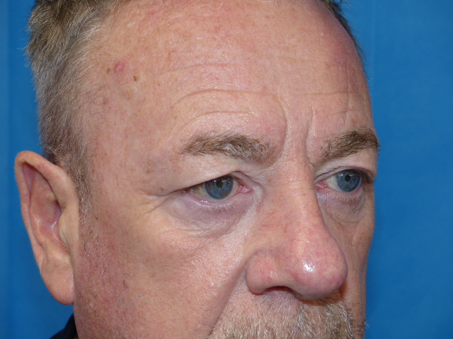 PM Upper Eyelid Side Before PM Upper Eyelid Side Before