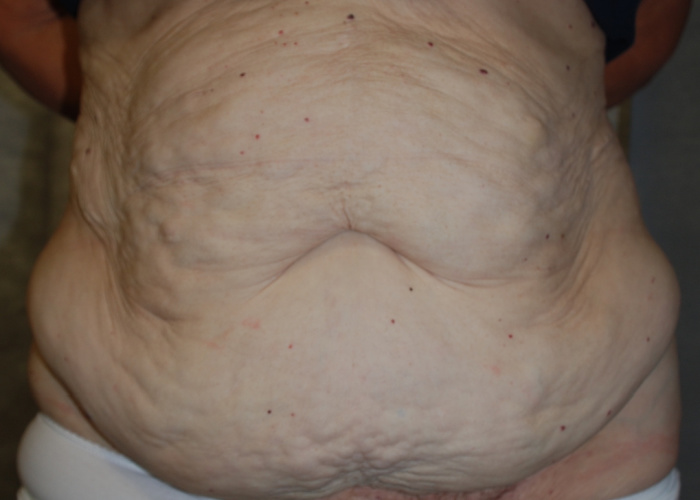 Post weight loss surgery 1 before