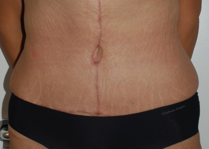 Post weight loss surgery 2 after