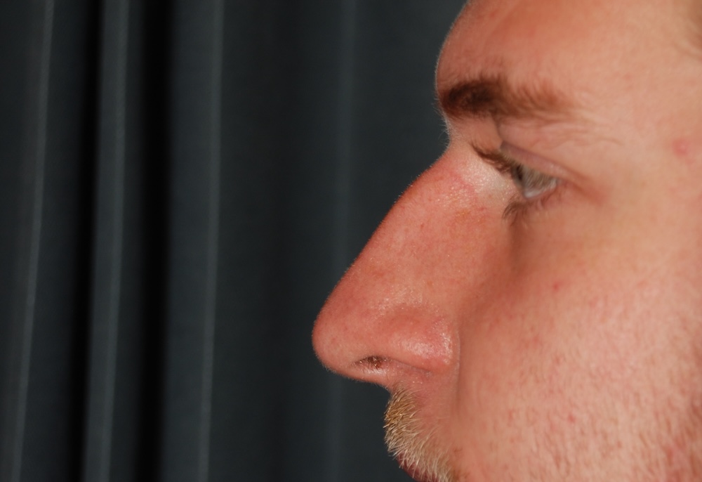 SN Rhinoplasty Before SN Rhinoplasty Before