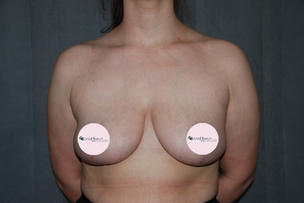 SW BBR Breast Reduction After
