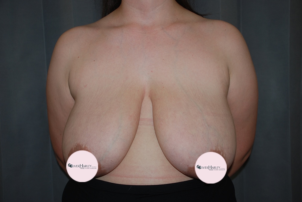 SW BBR Breast Reduction Before