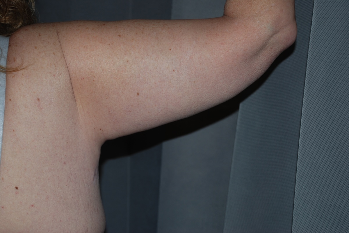 TMcC Brach Arm Lift After