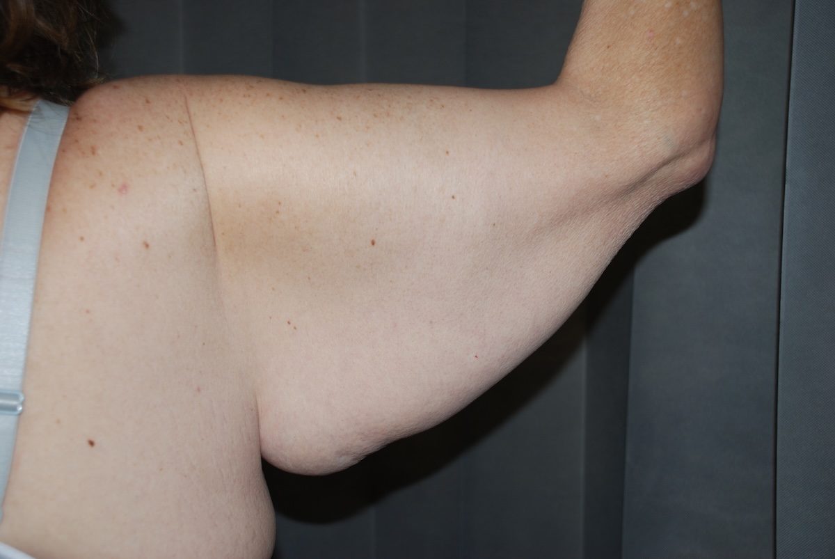 TMcC Brach Arm Lift Before