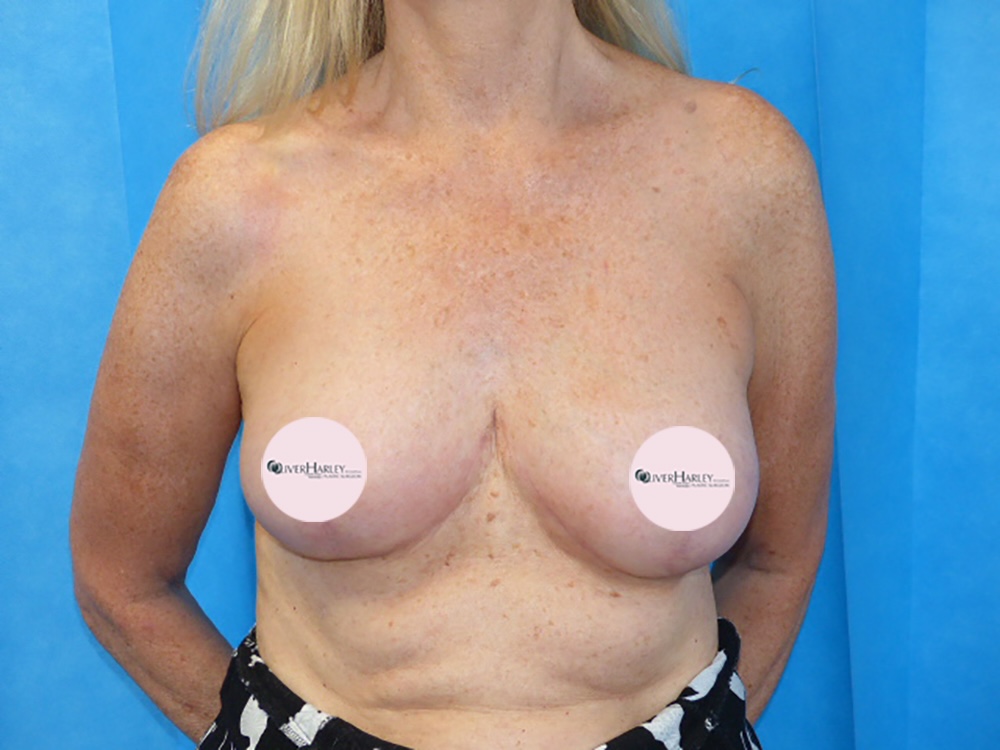 TS BBR Breast Reduction After