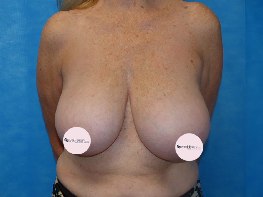 TS BBR Breast Reduction Before