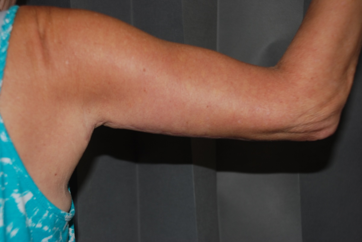 VH Branch Arm Lift After